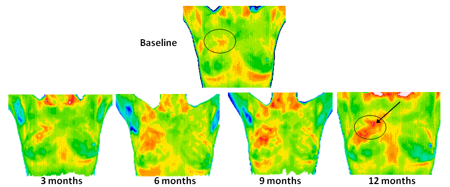 Thermography DIDI